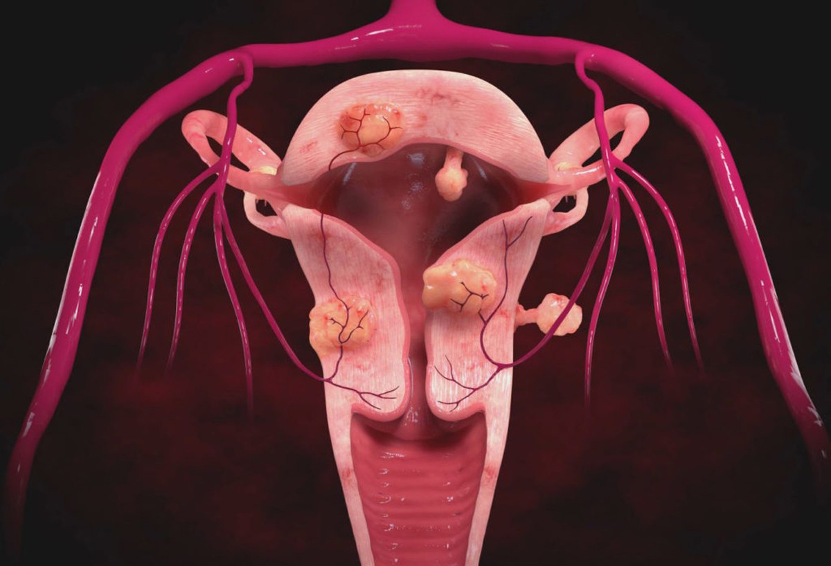 Эндометрий 24. Интрамуральная лейомиома матки. Пролиферирующая миома.