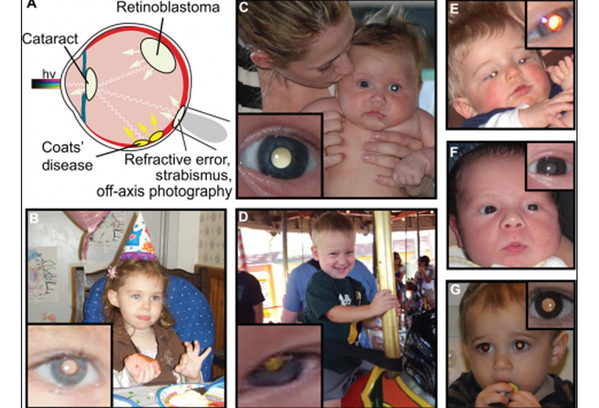 Глаза после прививки. Ретинобластома лейкокория. Ретинобластома глаза у детей. Ретинобластома у детей симптомы.