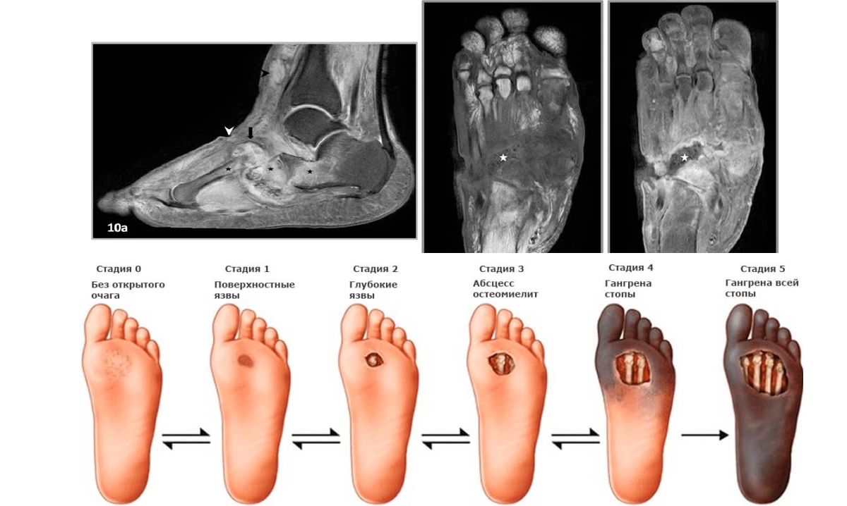 Сухая Гангрена Пальцев Ног Фото